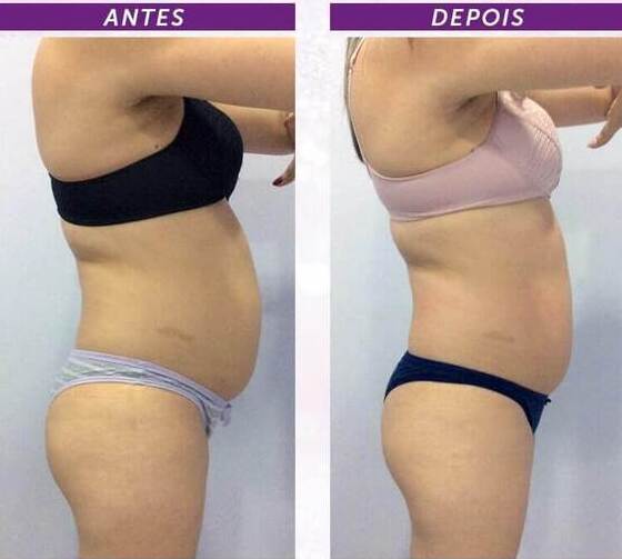 antes-e-depois-massagem-modeladora-4